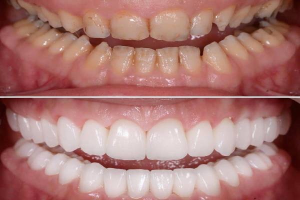 Full Mouth Rehabilitation