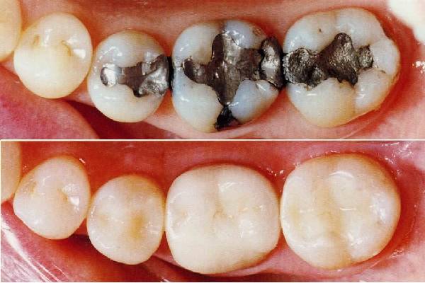 Tooth-Coloured Fillings