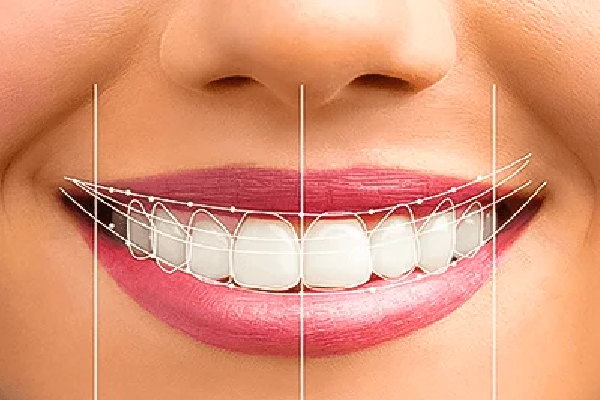 Smile Designing